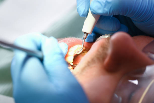 Best Emergency Root Canal Treatment in Varnville, SC