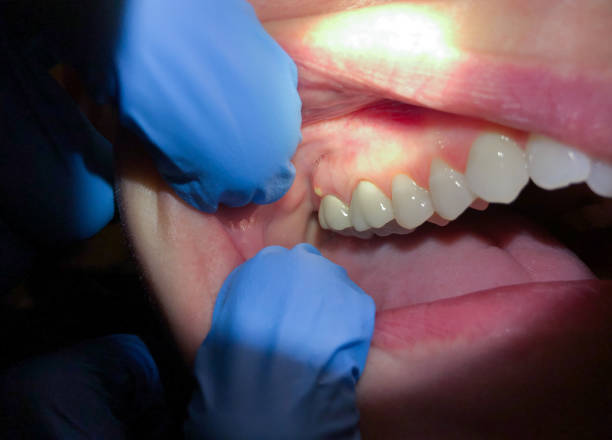 Best Emergency Dental Care for Broken or Chipped Teeth in Varnville, SC