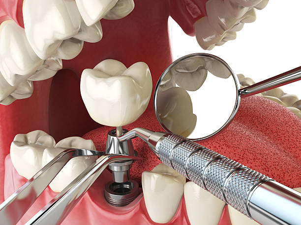 Best Emergency Treatment for Dental Infections or Abscesses in Varnville, SC
